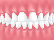 クリアブラケットなら岡崎市の岡崎エルエル歯科 矯正歯科まで 岡崎市で矯正治療なら岡崎エルエル歯科 矯正歯科まで