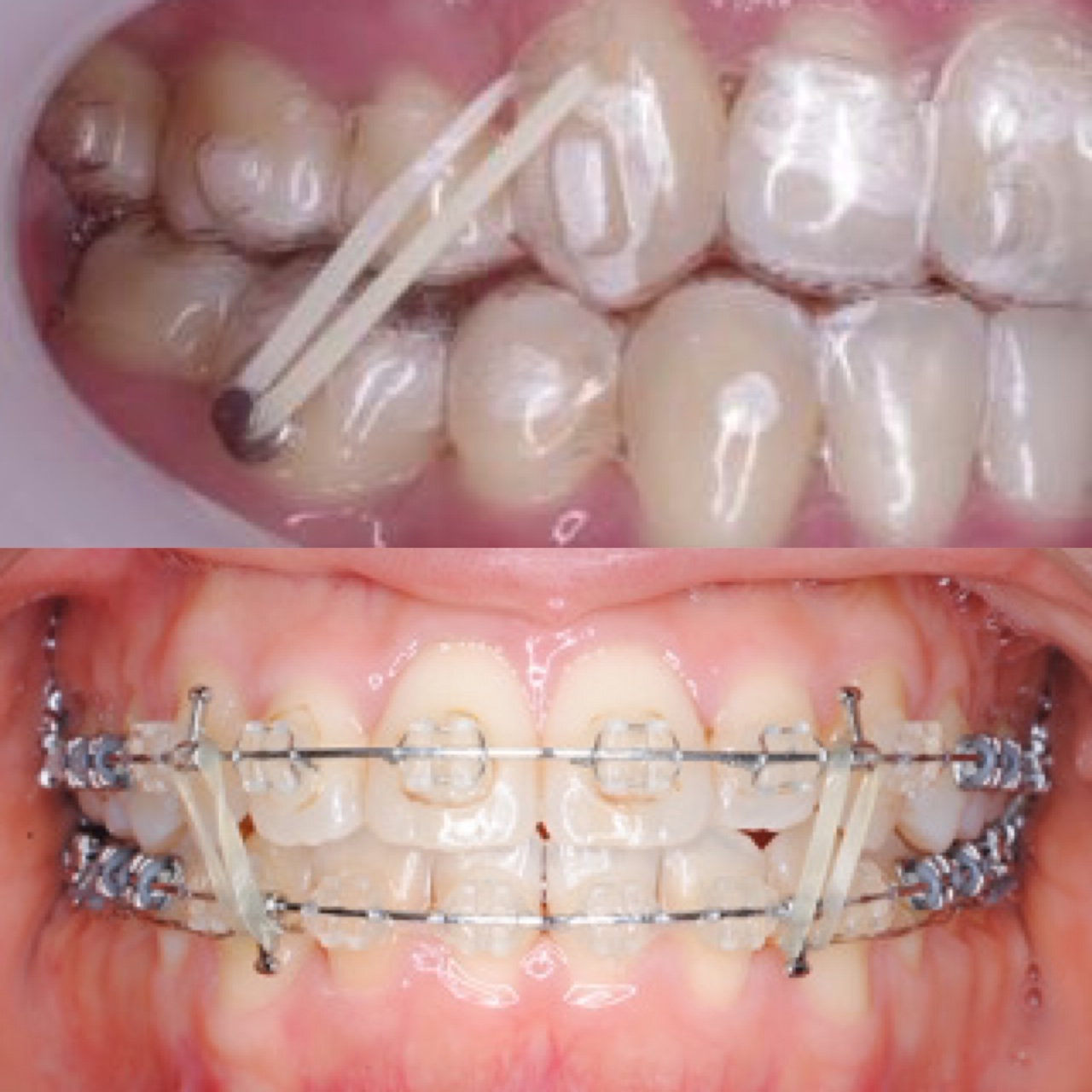 顎間ゴム知っていますか 岡崎市で矯正治療なら岡崎エルエル歯科 矯正歯科まで 岡崎市で矯正治療なら岡崎エルエル歯科 矯正歯科まで